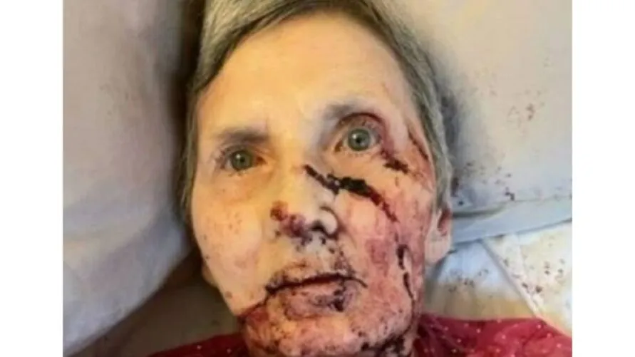 Idosa de 76 anos é atacada por ratazana enquanto dormia