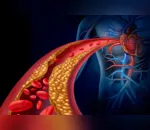 Presentes em níveis elevados no sangue, o colesterol ruim pode fazer com que a gordura se aloje nas paredes internas das artérias