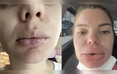 Nutricionista tem necrose labial após preenchimento malsucedido
